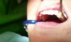 Blanqueamiento dental - Dentista en Guadix