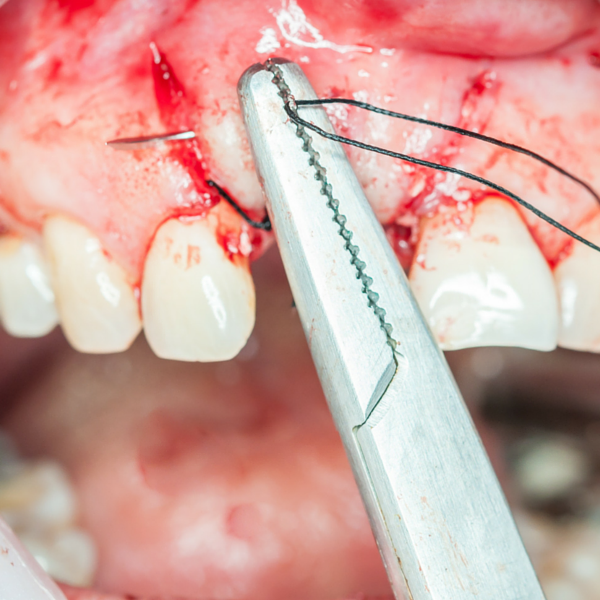 ejemplo de apisectomía realizada en clínica dental