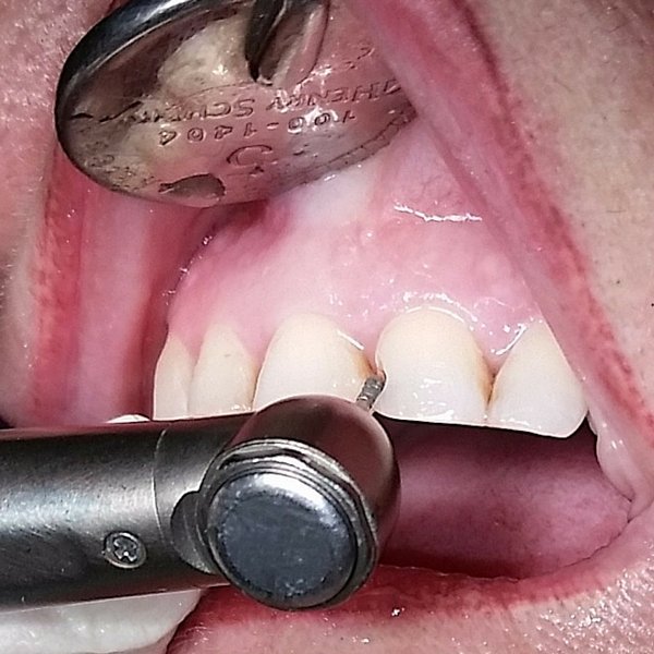 empaste dental en dientes frontal - dentista Laura Poyavos en Guadix