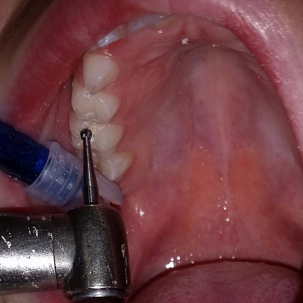 empaste dental a un niño - dentista Laura Poyavos en Guadix