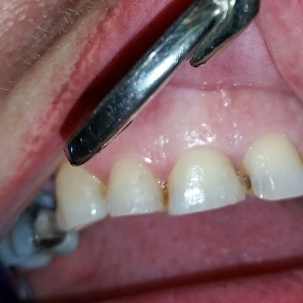 ejemplo de empaste dental - dentista Laura Poyavos