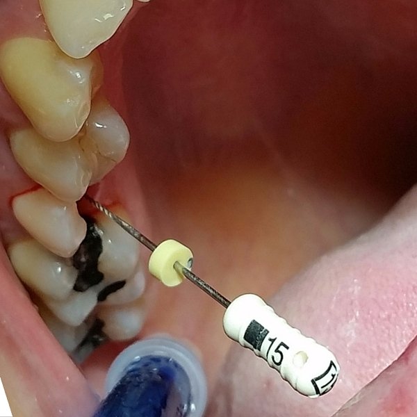 endodoncia en adulto realizada por la Dentista Laura Poyatos