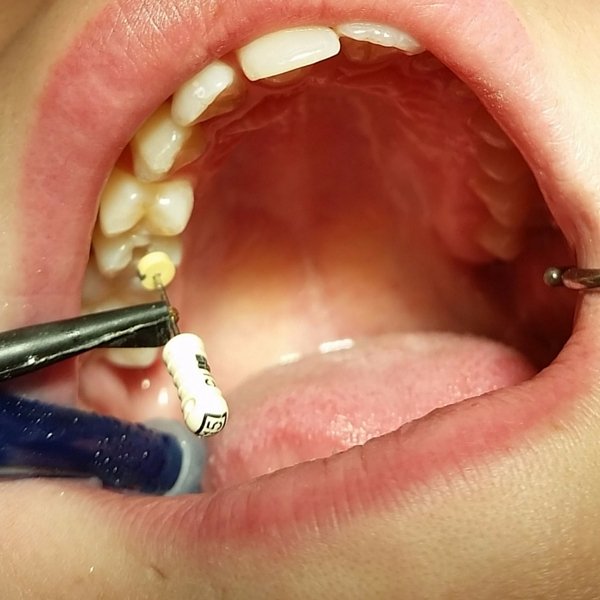 endodoncia realizada en la clínica dental de Guadix