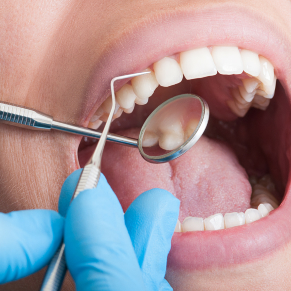 limpieza dental practicada por dentista experto