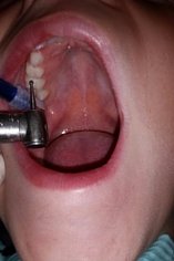 Empaste dental realizado a un niño