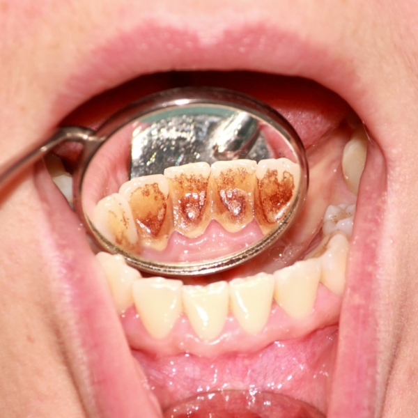ejemplo claro de necesidad de limpieza dental por fumador - Dentista Guadix