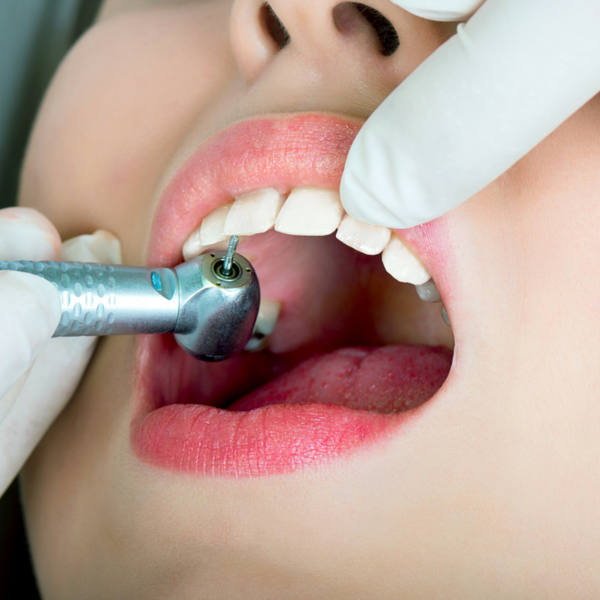 limpieza dental - Dentista Guadix