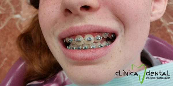 Ejemplo de Brackets colocados en la clínica de la dentista Laura Poyatos