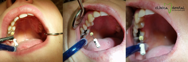 Proceso de cómo se realiza una endodoncia realizada en Dentista Guadix 