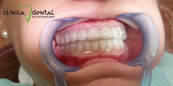 ¿Es bueno el bicarbonato para blanquear los dientes? te responde esta duda la Dentista Laura Poyatos