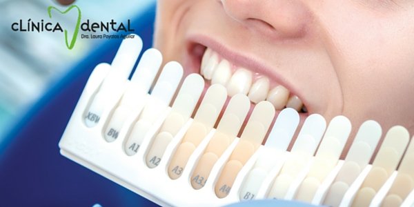 carillas dentales para mejorar es aspecto de tus dientes