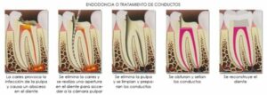 imagen proceso endodoncia
