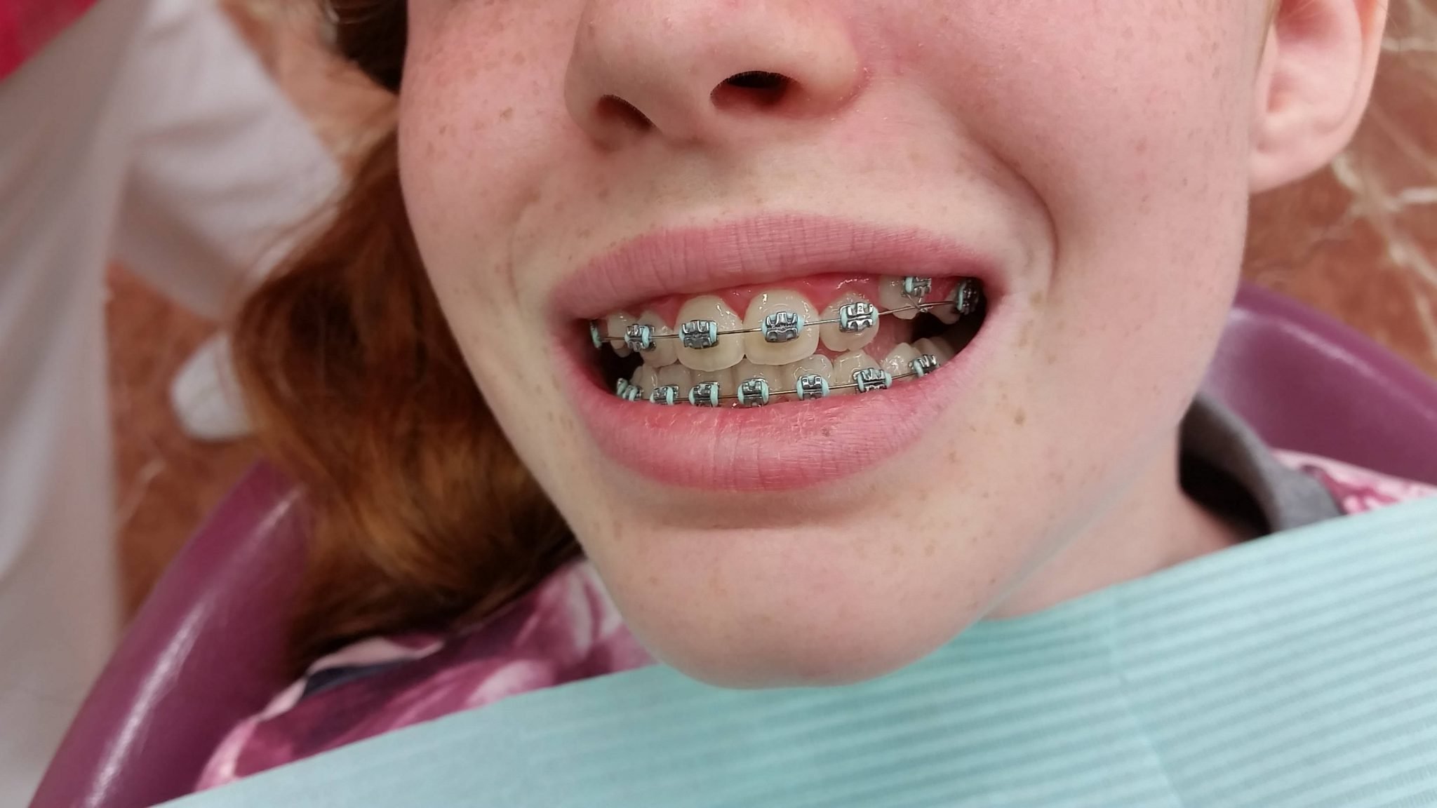 Los brackets cambian la forma de la cara? Realidad o mito