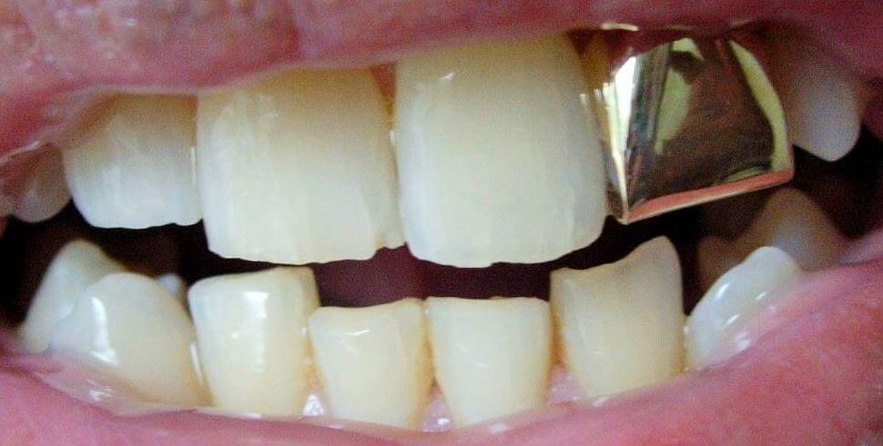 Fundas o coronas dentales, ¿Qué son?