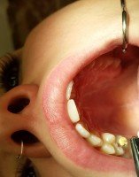 Qué es una Endodoncia - Dentista en Guadix, Granada