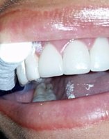 Corona dental, prótesis dental fija