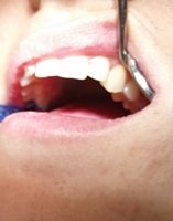 Prótesis dental de resina - Dentista Guadix