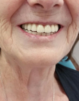reconstrucción dental en persona mayor - Dentista en Guadix Dra Laura Poyatos